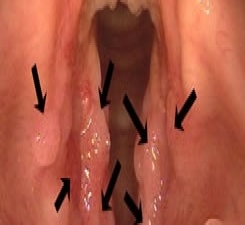 papilomatoza hrtanu 2