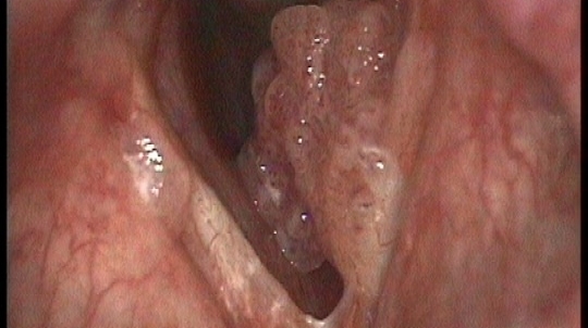 papilomatoza hrtanu